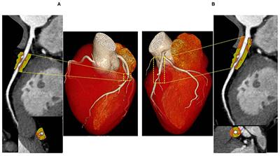 Influence of Different Segmentations on the Diagnostic Performance of Pericoronary Adipose Tissue